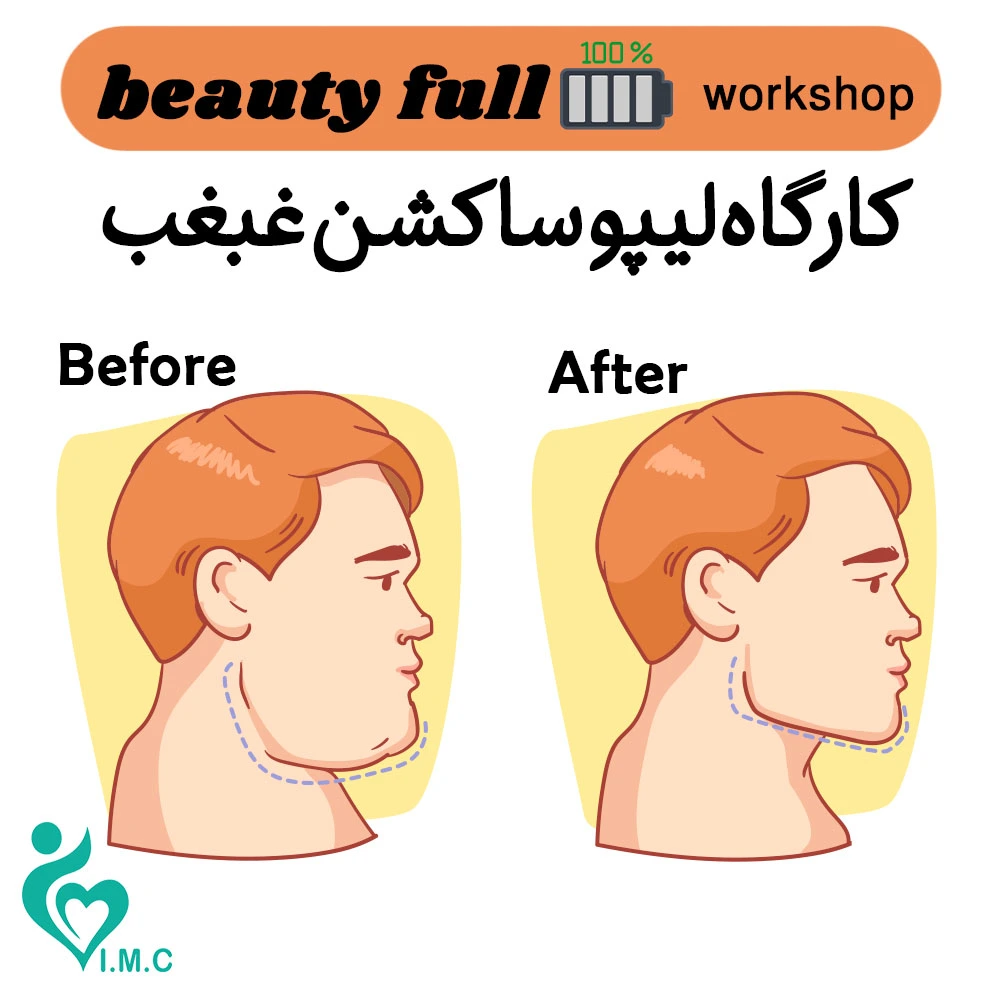 Beauty Full🔋 Workshops- کارگاه آموزشی لیپوساکشن غبغب